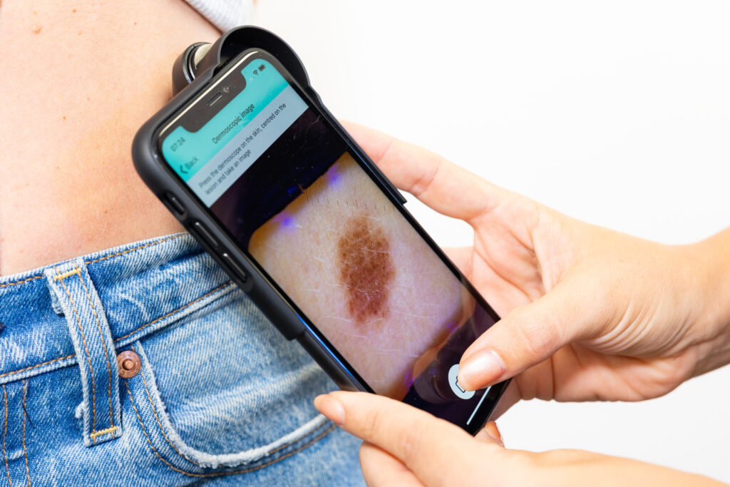 Diagnosis of skin cancer